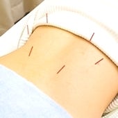 iCure鍼灸接骨院 目白の「鍼灸施術」の写真