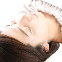 美顔鍼の施術イメージ