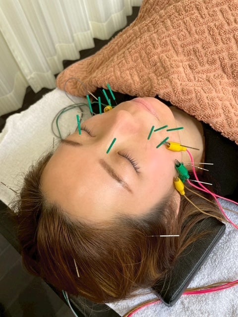 【まずはベーシック美容鍼でお試し★】の写真