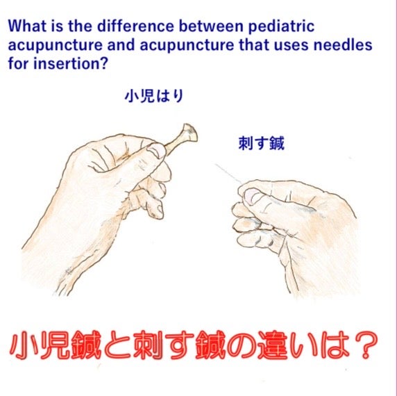 小児鍼と刺す鍼のちがいは？の写真