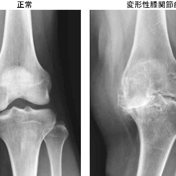 モアはりきゅう整骨院の変形性膝関節症の写真