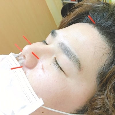 介正鍼灸整骨院　ボックスタウン箱崎の鼻炎の症状鍼灸の写真
