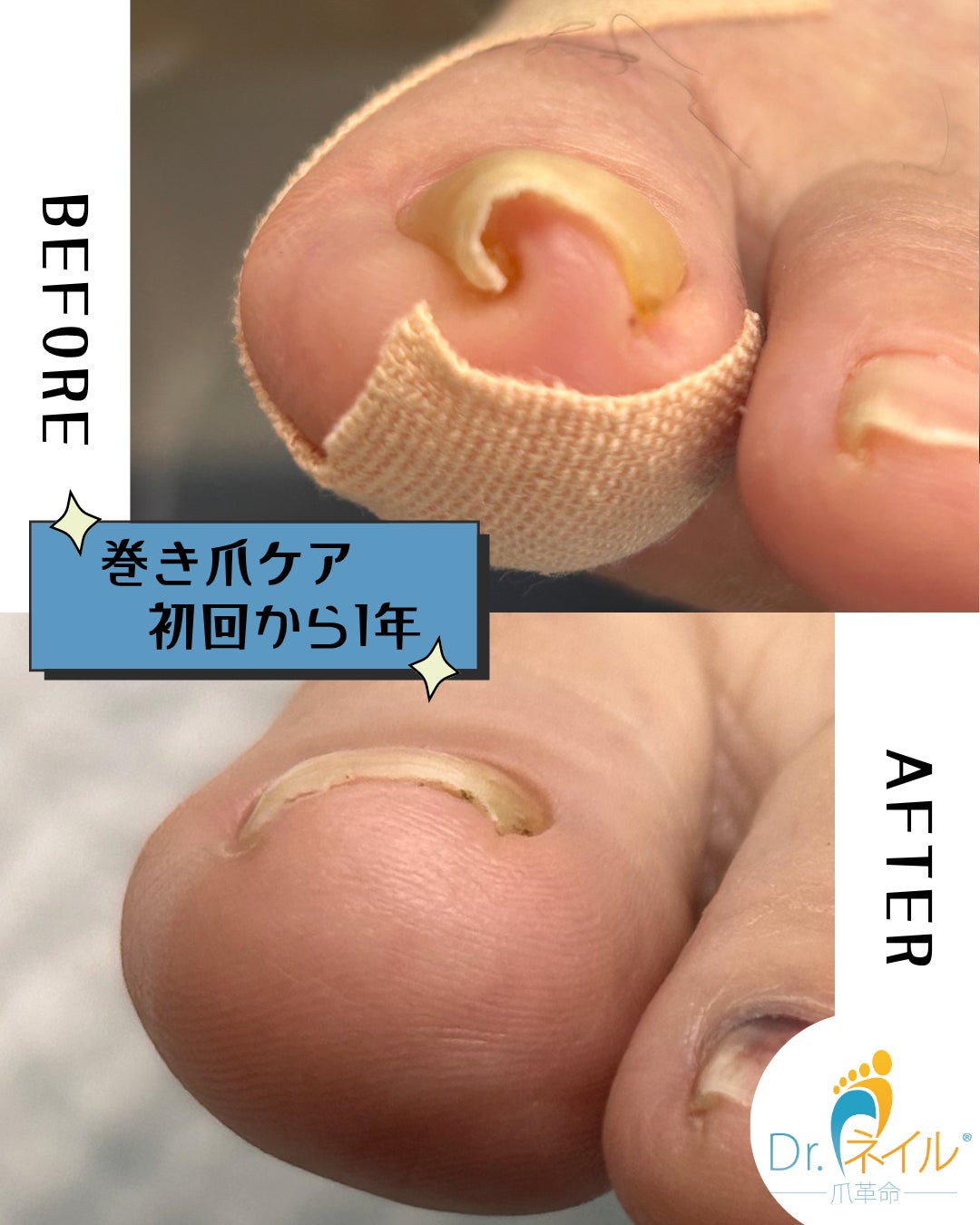 ドクターネイル爪革命　群馬両毛店の巻き爪ケアの写真
