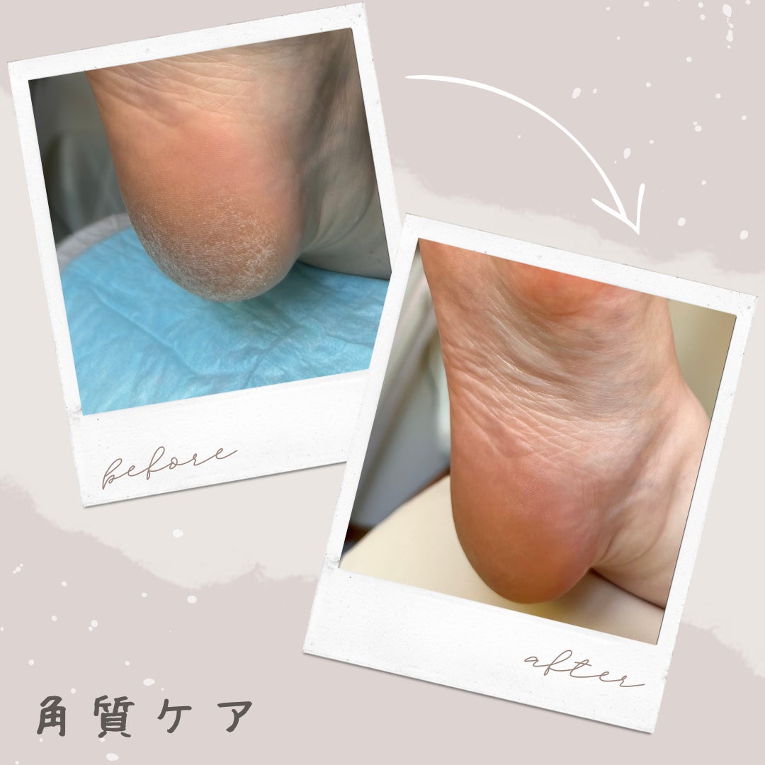 ドクターネイル爪革命　群馬両毛店の角質ケアの写真