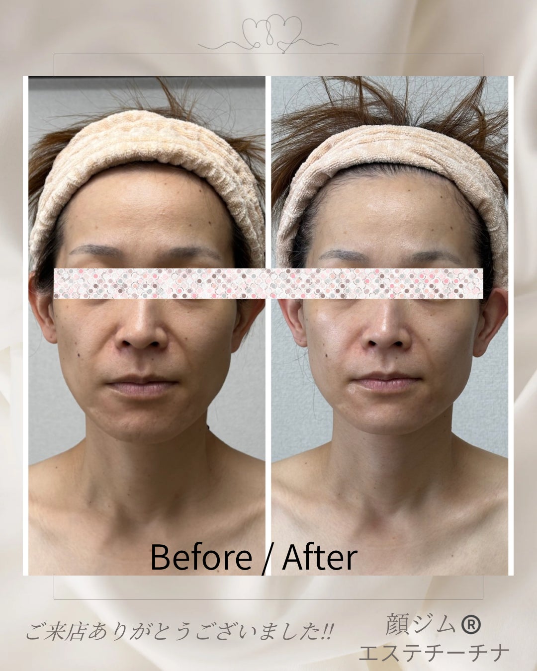 エステ　チーチナの小顔造顔メソッド（ドライヘッドスパ付）の写真