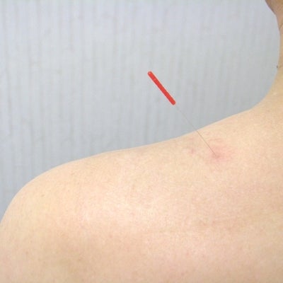 サンテ鍼灸整骨院の肩こり・腰・ひざ・神経の症状に効果的な鍼灸施術の写真