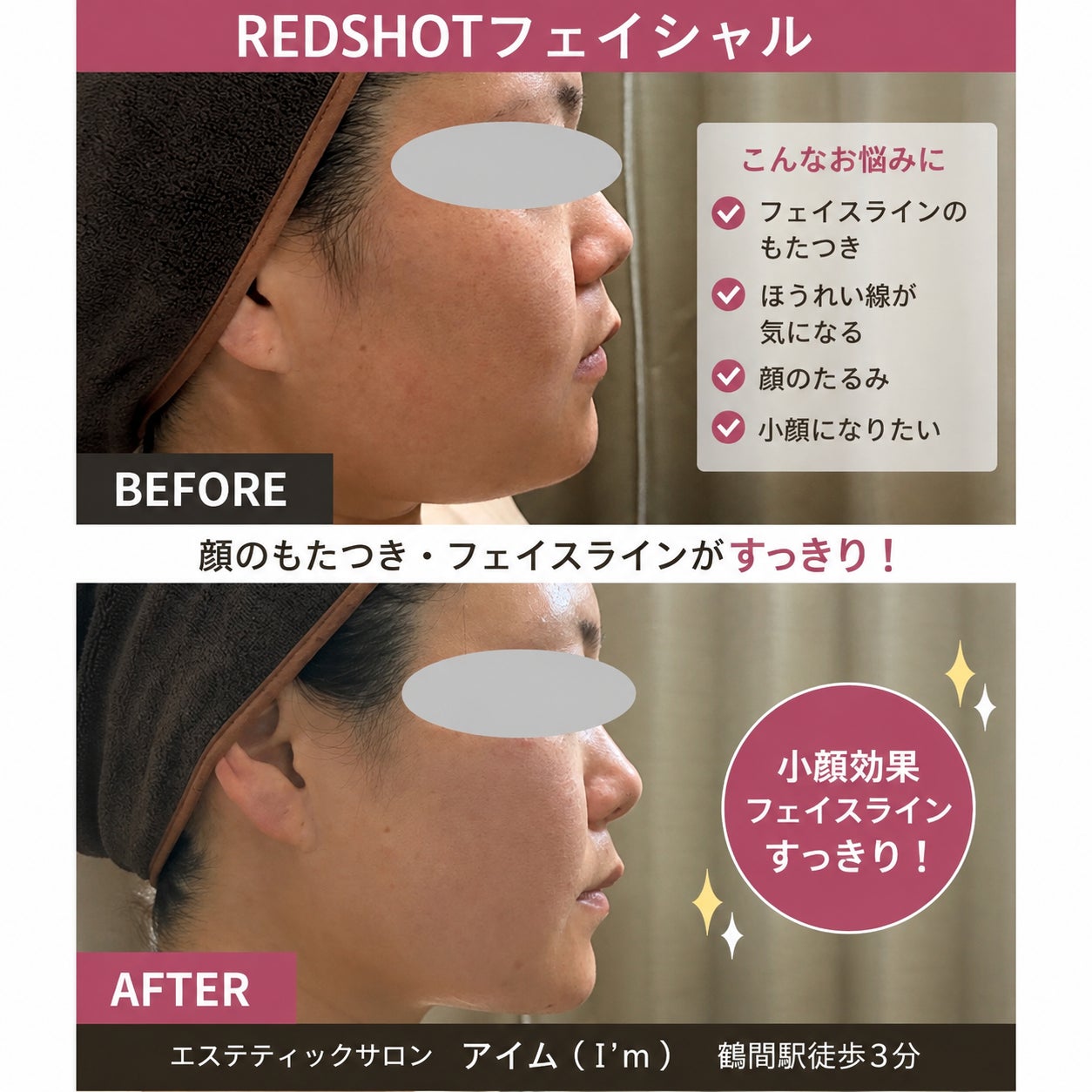 エステティックサロン アイムの【フェイスライン・もたつきが気になる方に♪REDSHOTフェイシャル】の写真