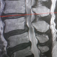 脊柱管狭窄症は、脊柱管と呼ばれる脊椎骨が囲む管が狭くなる状態です。の写真