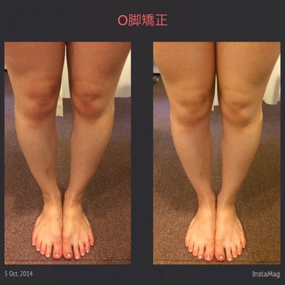 O脚矯正 (30代女性 Before & After)