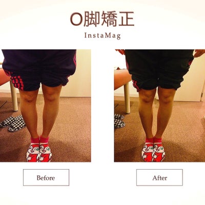 O脚矯正 (20代女性 Before & After)