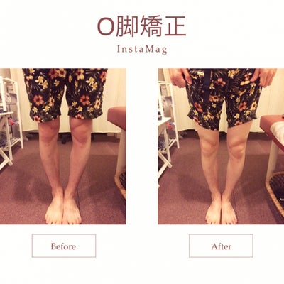 O脚矯正 (30代男性 Before & After)