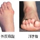 健康道場FENSの外反母趾と浮き指の”無料診断実施中の写真