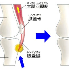 坂東接骨院のオスグット　：　成長期でひざの下が腫れる。の写真_3枚目