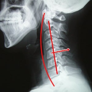 ほり川整骨院KAATSUライフ鍼灸院のムチ打ち・寝違えなどによる首の痛みの写真