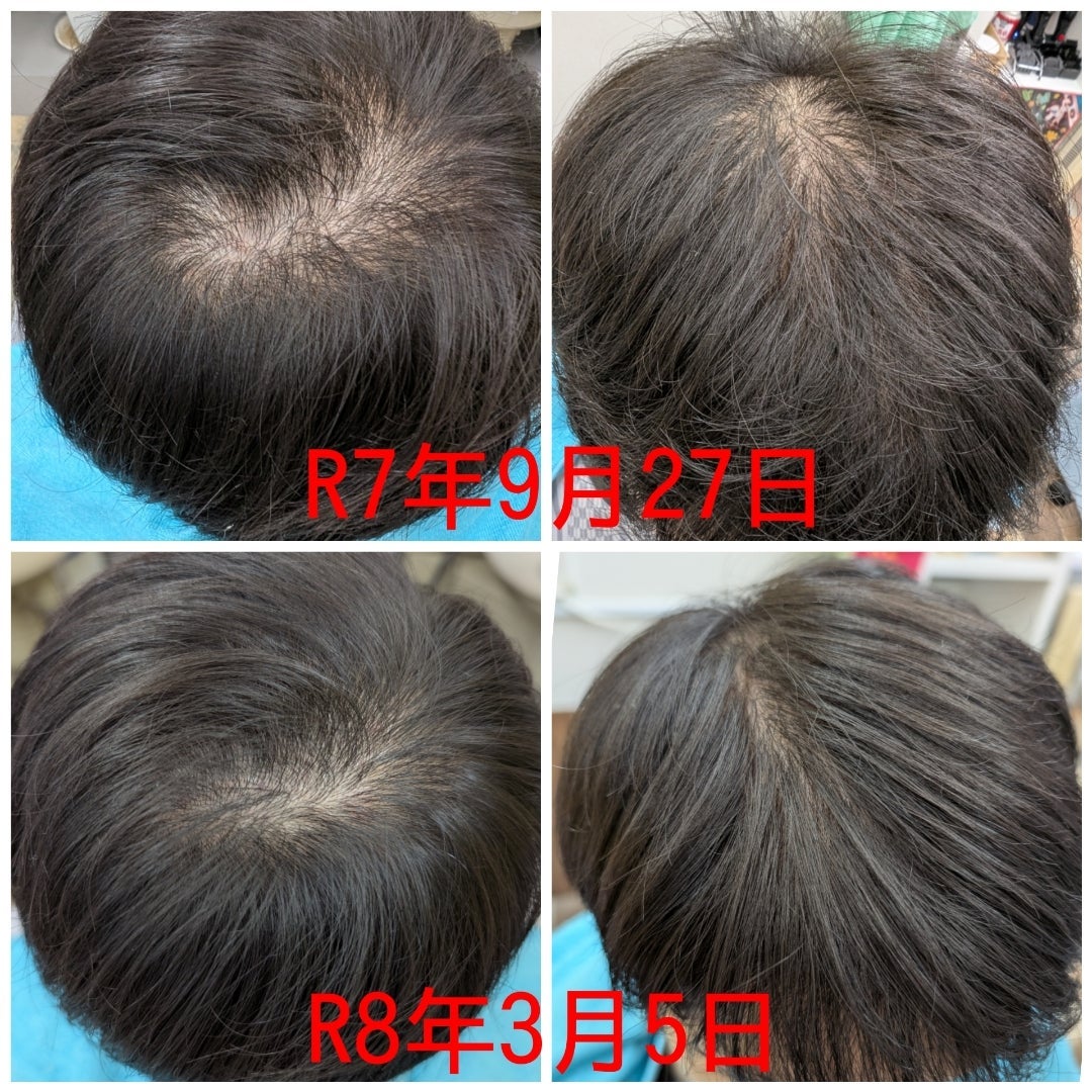 ヘアー&フェイシャル Lien〜リアン〜の幹細胞培養上清液発毛ケアの写真