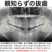 ウエノデンタルクリニックの親知らずの抜歯の写真