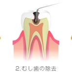虫歯に塗布することで、虫歯部分のみを軟らかく溶かし、それを特殊な器具で除去していく治療法