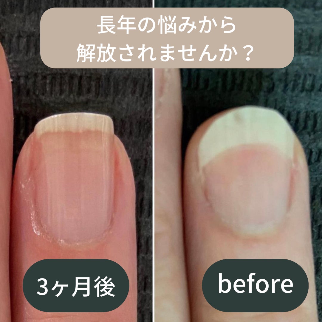 Deco*Riddim  デコリディムの自爪育成ケア3ヶ月コースの写真