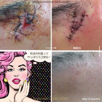にしやま由美東京銀座クリニックの顔の傷の再縫合の写真