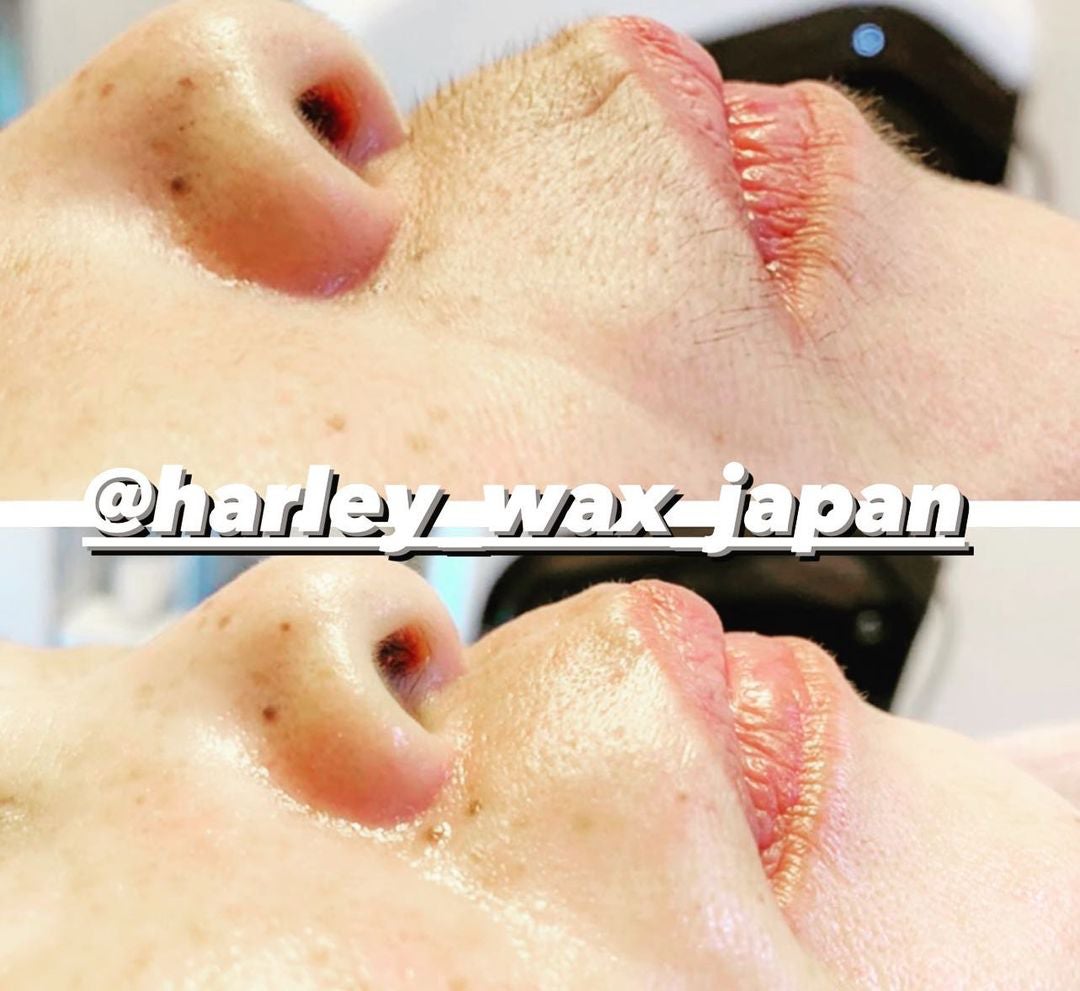 PrivateSalon Vinosの遂にマスク解禁！！自信の持てるツルツルお肌に♡フルフェイスwax脱毛♡の写真