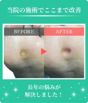 巻き爪矯正院フルフィル　高田馬場店の【初めての方】たこ・魚の目・かかとなど角質トラブルでお悩み   5,500円 (税込) ～の写真