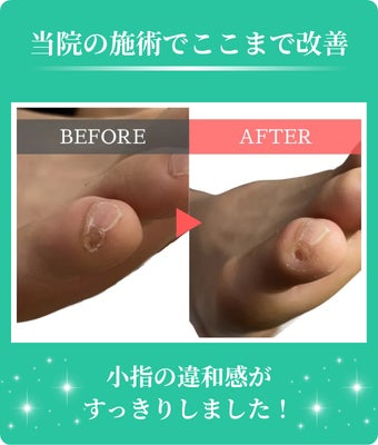 巻き爪矯正院フルフィル　高田馬場店の【初めての方】副爪（小指横の角質）のお悩み   5,500円 (税込) ～の写真