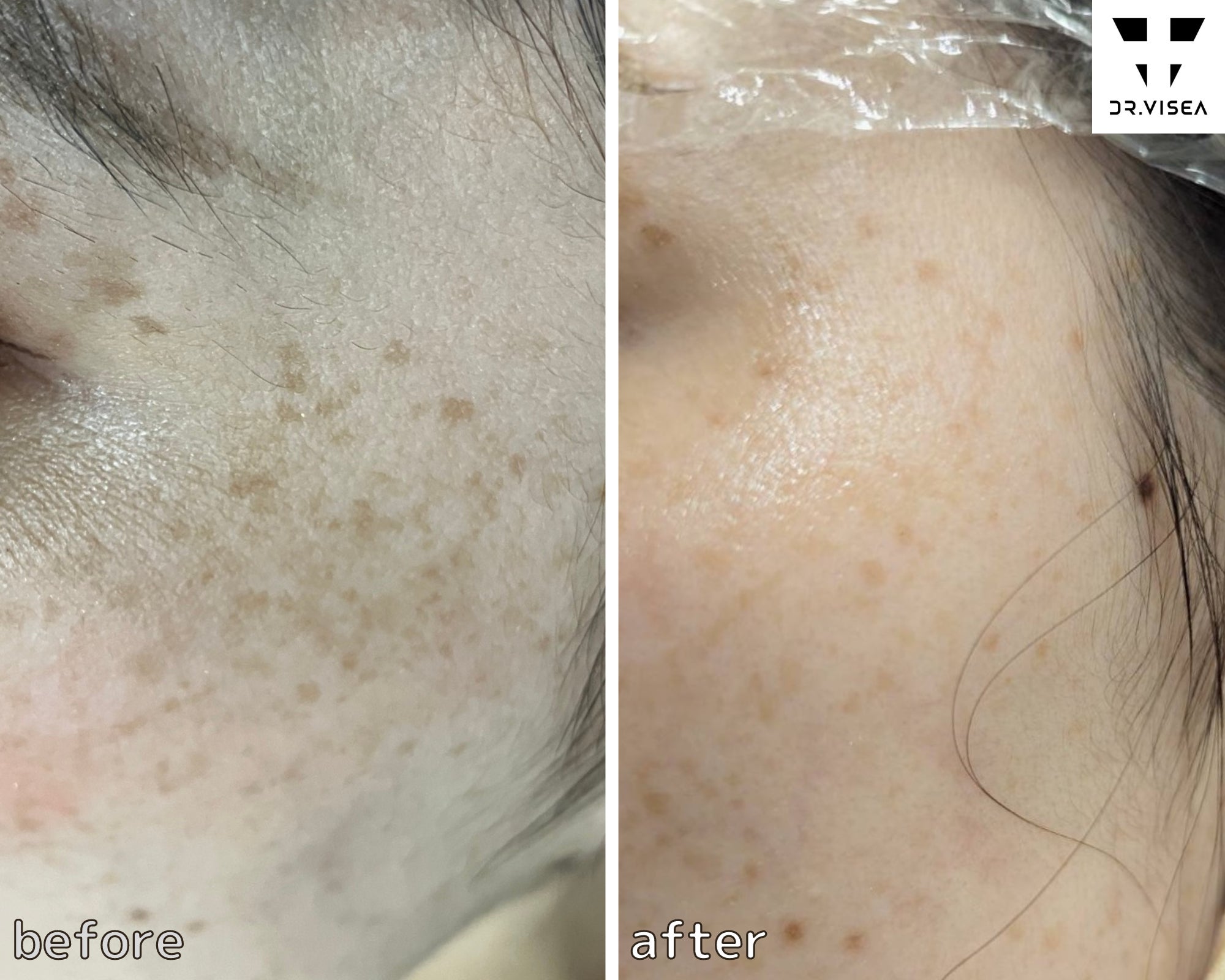Salon de MiroのシミケアフェイシャルL｜定価の写真