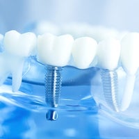 表参道AK歯科・矯正歯科のインプラントの写真
