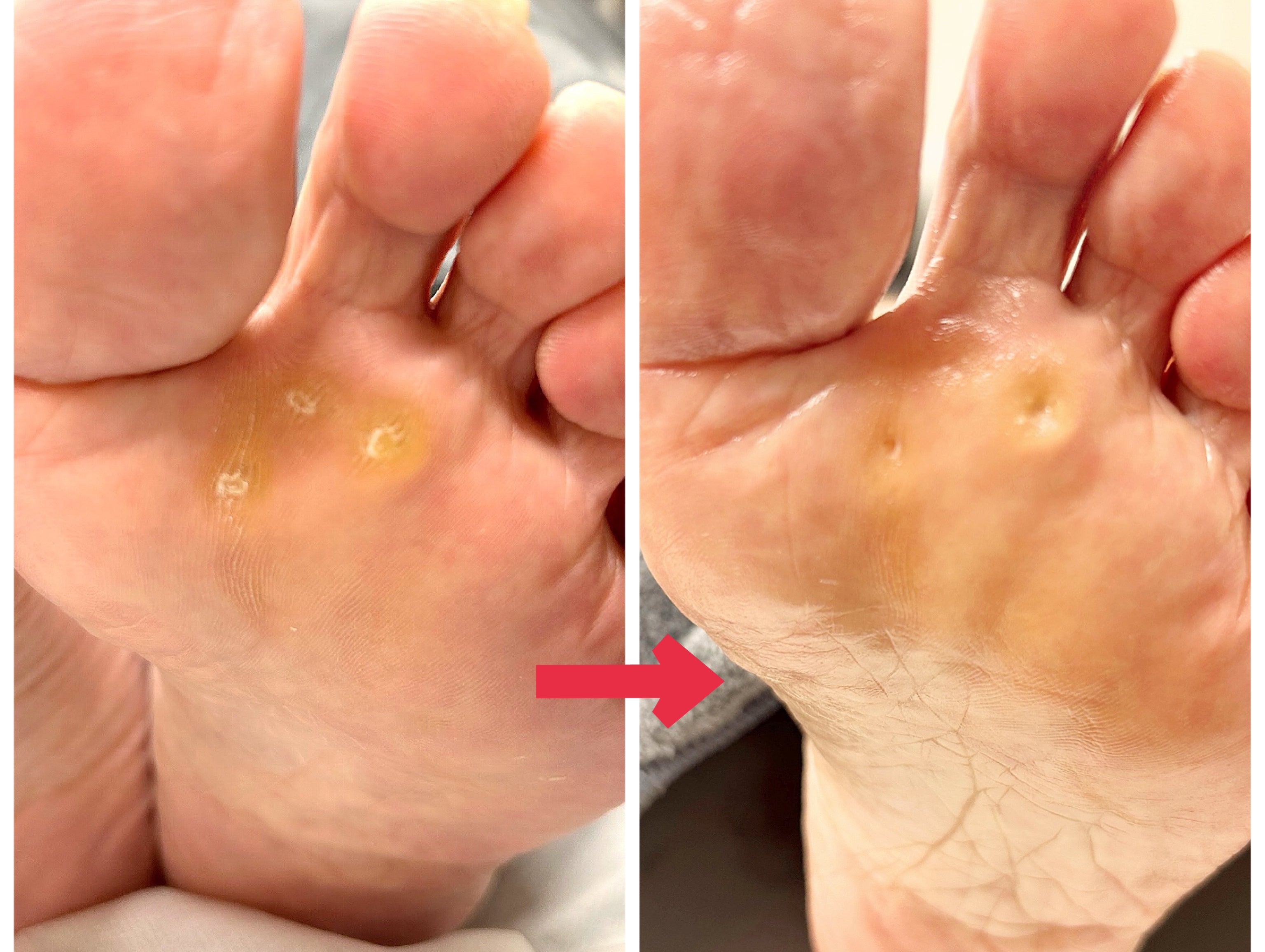  足の裏の硬いところ、ずっと気になっていませんか？の写真