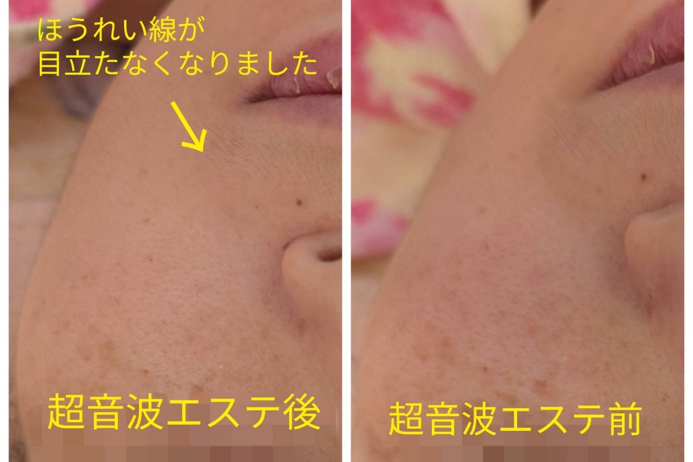 コスメゆいの超音波エステの写真
