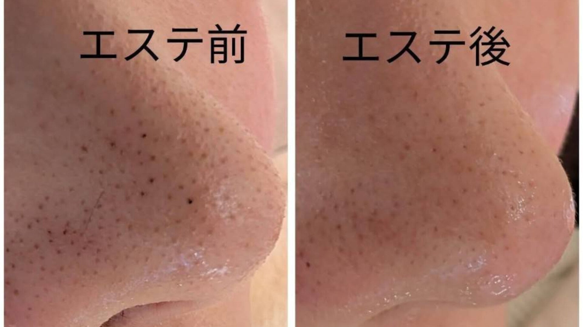 コスメゆいの毛穴角栓詰まり・角質スッキリエステの写真