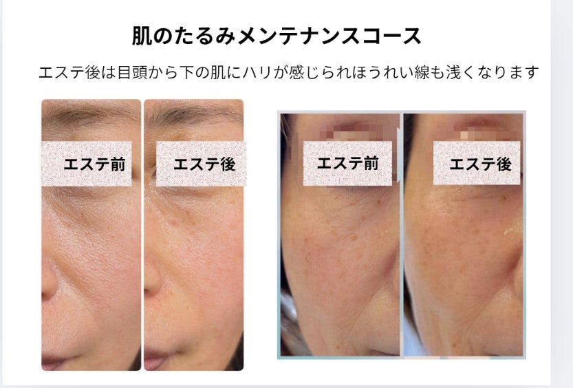 コスメゆいの肌のたるみメンテナンスエステの写真