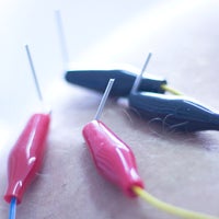 あおぞら鍼灸接骨院の電気鍼療法の写真