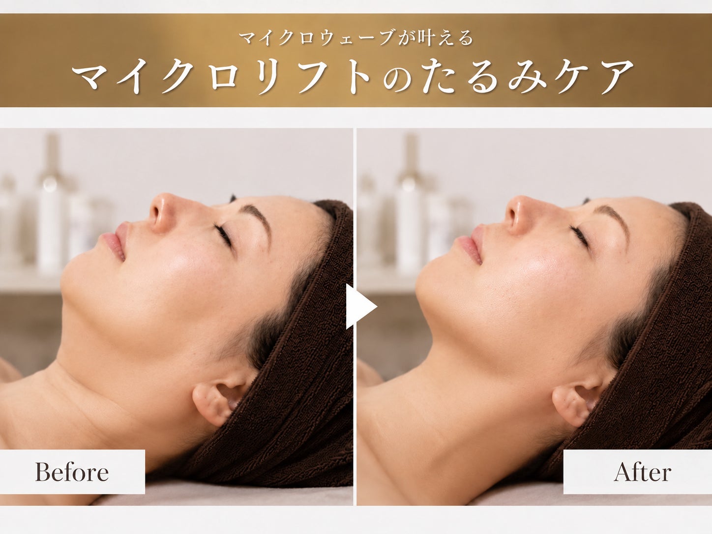 Silky A Beauty 【シルキーエービューティー】浅草　脱毛　フェイシャルの【韓国小顔リフトアップ】　マイクロ小顔リフト　全顔の写真
