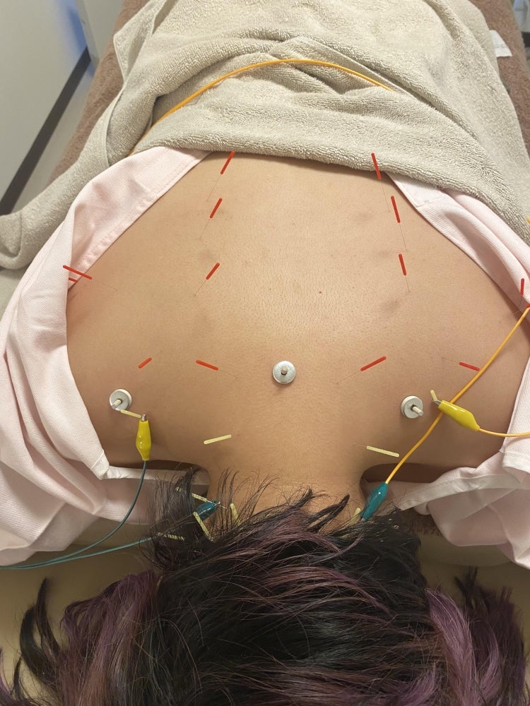 鍼灸サロン　パレットのメニューの写真 - 肩首の鍼