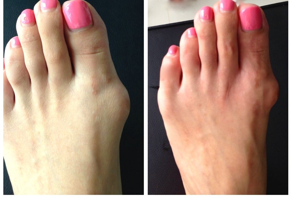 外反母趾矯正専門整体 ユニファイのその他の写真 - 矯正前とその後の比較